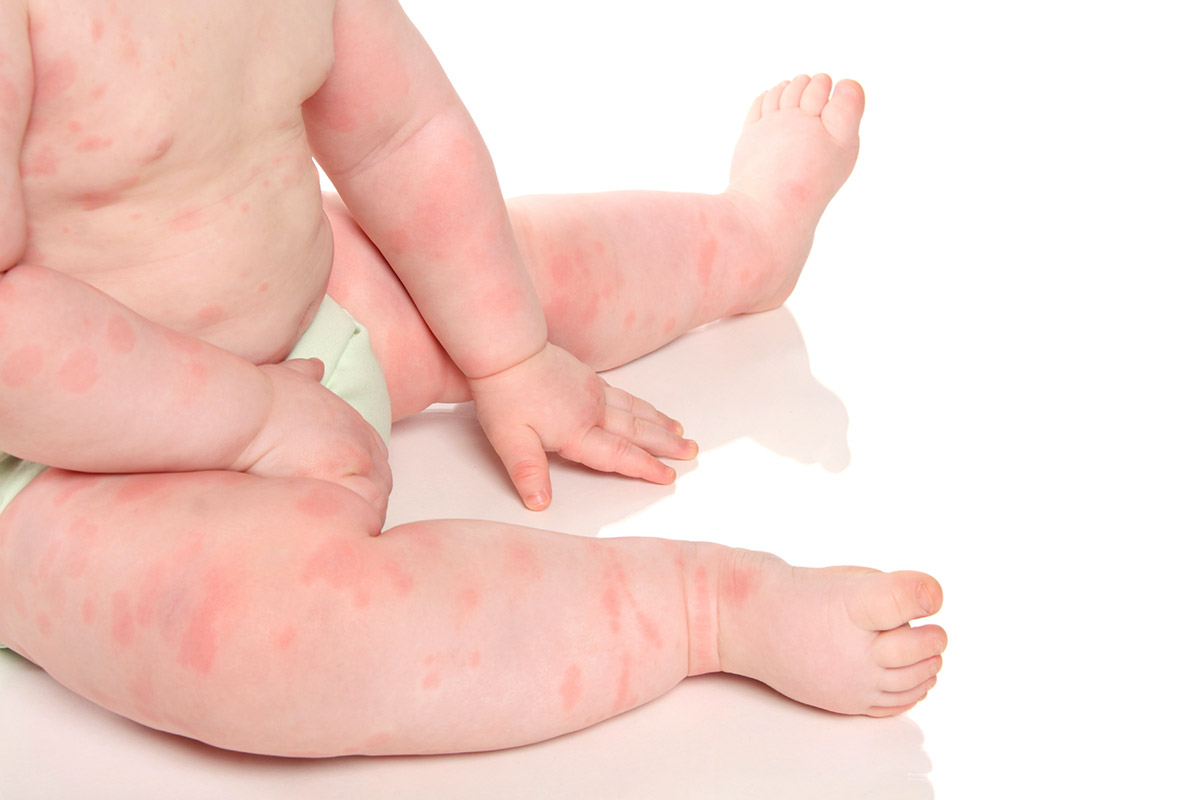 Baby Heat Rash Pictures Symptoms and Treatment