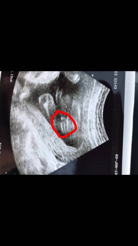 Ultraschall Babyscans Bub Oder Madchen 1 Babyforum At