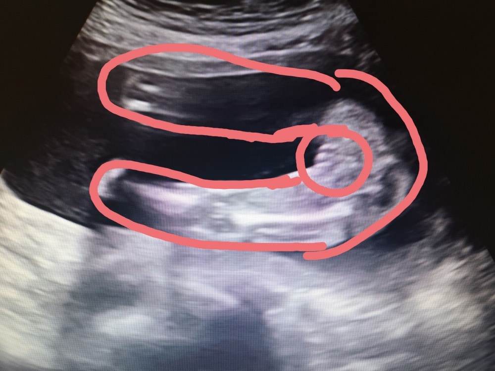 Junge 13 ssw ultraschall Ultraschall junge